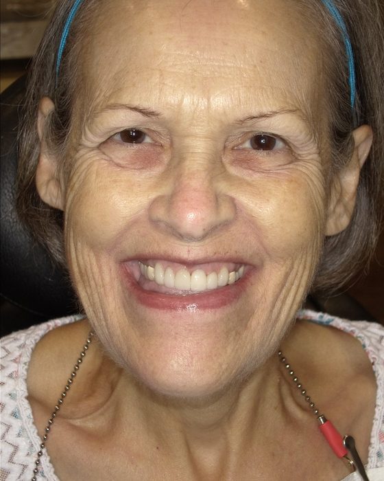 A patient smiling widely after full-arch implant treatment at Valley Family Dental