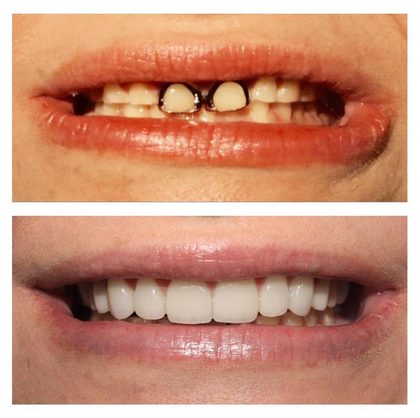 Before and after photographs of a Valley Family Dental patient. Several missing and broken upper front teeth rebuilt into a complete, even smile.