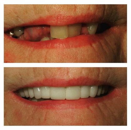 Before and after photographs of a Valley Family Dental patient. Missing upper teeth and an old gold crown replaced with a full, natural-looking arch.