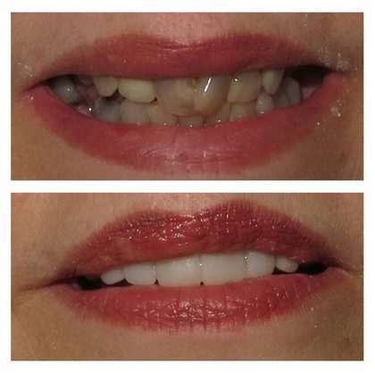 Before and after photographs of a Valley Family Dental patient. Dark, broken and missing teeth restored to an even, healthy-looking smile.