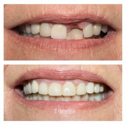 Before and after photographs of a Valley Family Dental patient. A single missing upper tooth replaced so the gap no longer shows.