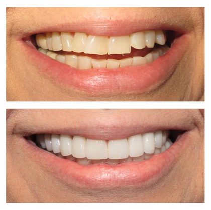 Before and after photographs of a Valley Family Dental patient. A worn, uneven smile rebuilt to full, even upper teeth.