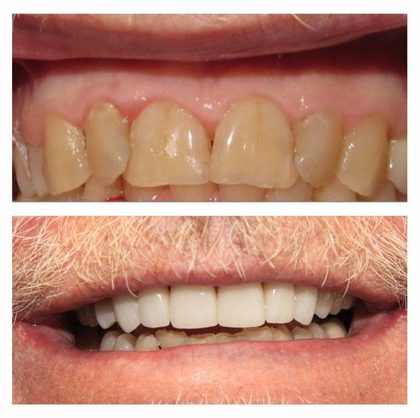 Before and after photographs of a Valley Family Dental patient. Short, worn-down teeth rebuilt to a fuller length and a brighter shade.