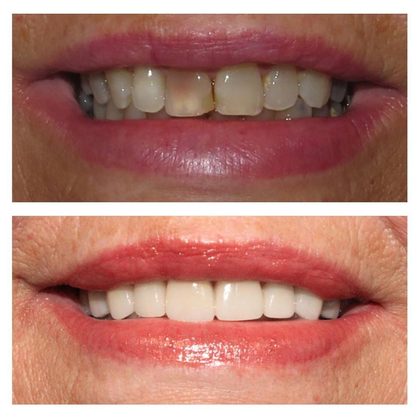 Before and after photographs of a Valley Family Dental patient. Worn upper teeth with dark gaps restored to a clean, even edge.