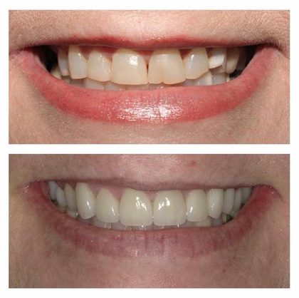 Before and after photographs of a Valley Family Dental patient. Worn front teeth with small spaces closed and evened out.