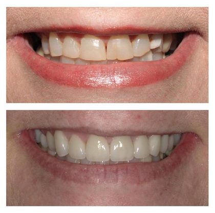 Before and after photographs of a Valley Family Dental patient. Chipped, uneven front teeth rebuilt to a natural shape.