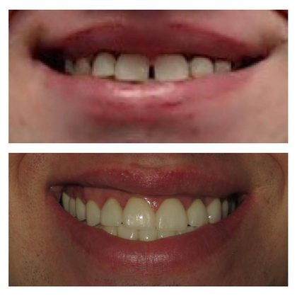 Before and after photographs of a Valley Family Dental patient. A gap between the front teeth closed and the worn edges evened out.