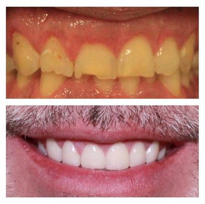 Before and after photographs of a Valley Family Dental patient. Heavy staining and an uneven upper arch replaced with a bright, even smile.