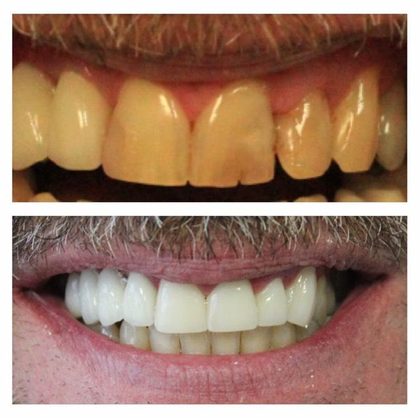 Before and after photographs of a Valley Family Dental patient. Deeply discolored, worn teeth restored to a natural, brighter shade.