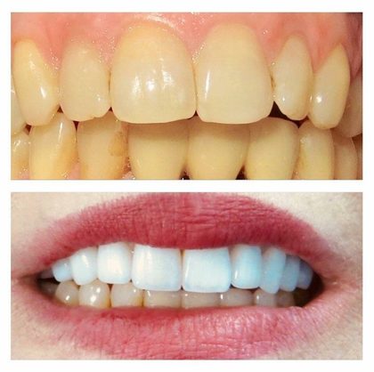 Before and after photographs of a Valley Family Dental patient. Yellowed enamel brightened by several shades.