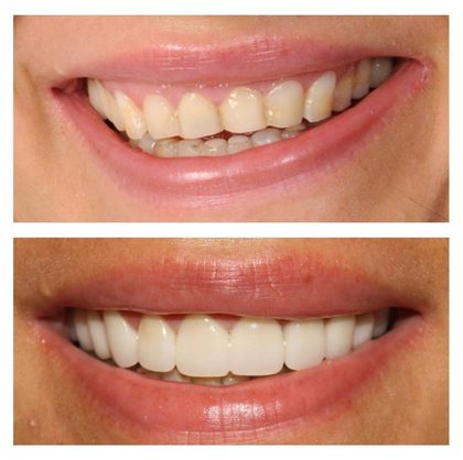 Before and after photographs of a Valley Family Dental patient. Crowded, discolored front teeth restored to a straight, bright smile.