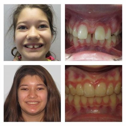 Before and after photographs of a Valley Family Dental patient. Crowded, crooked teeth straightened, shown in the smile and close up.