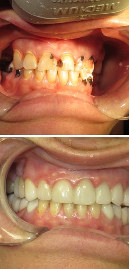 Before and after photographs of a Valley Family Dental patient. Widespread decay treated and restored with full-coverage crowns.