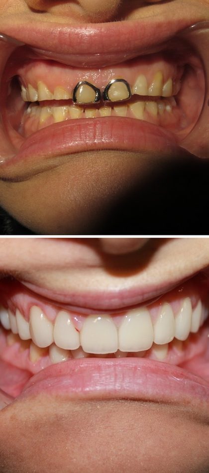 Before and after photographs of a Valley Family Dental patient. Failing front crowns with dark metal margins replaced with natural all-ceramic crowns.