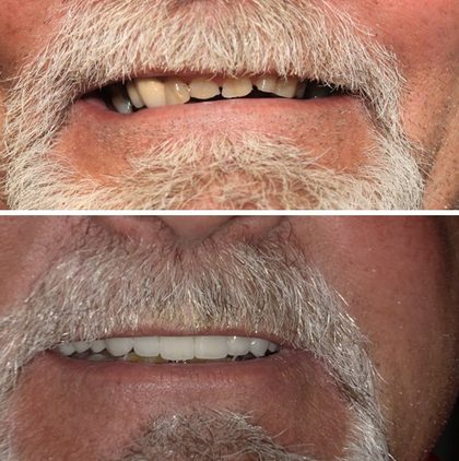 Before and after photographs of a Valley Family Dental patient. Severely worn front teeth rebuilt to full height and function.