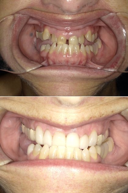 Before and after photographs of a Valley Family Dental patient. A complete upper-arch reconstruction, shown retracted before and after.