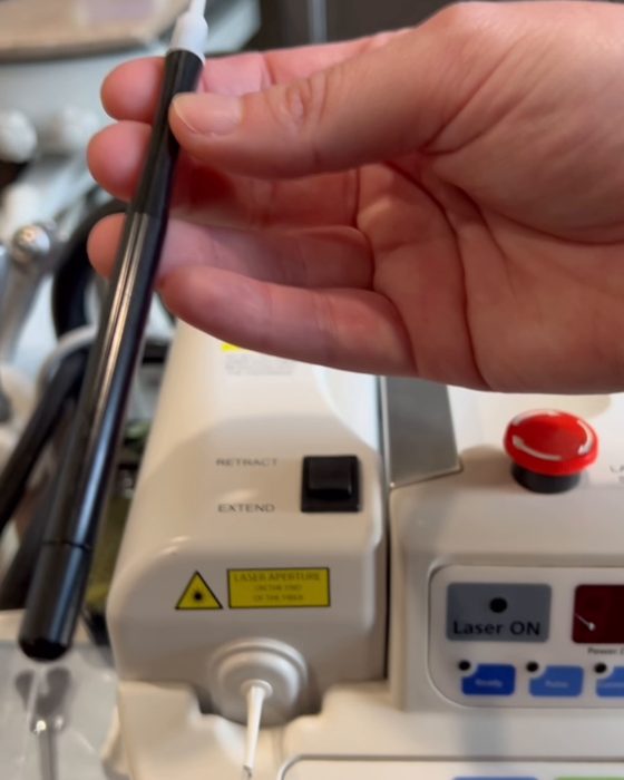 The dental laser used at Valley Family Dental to treat cold sores at the first sign of a flare-up