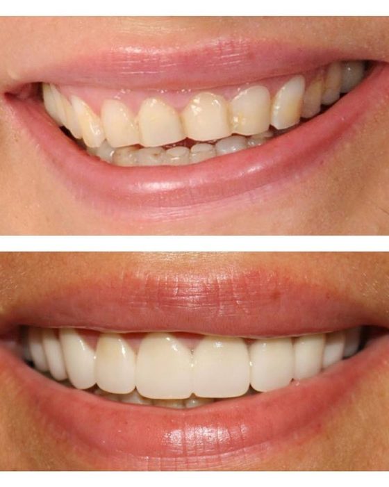 Before and after photos of a cosmetic smile makeover in natural light