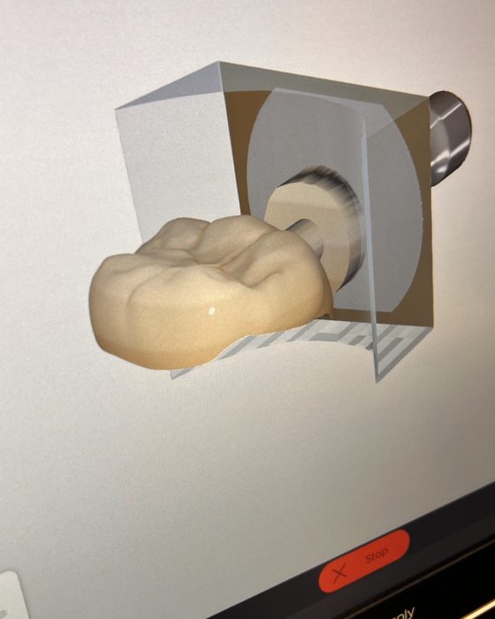 A digital 3D design of a ceramic restoration on the chairside milling screen