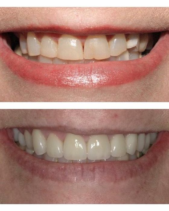 Before and after photos of worn, discoloured front teeth restored with veneers
