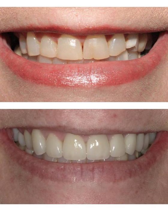 Before and after photos of a smile restored with a full set of replacement teeth