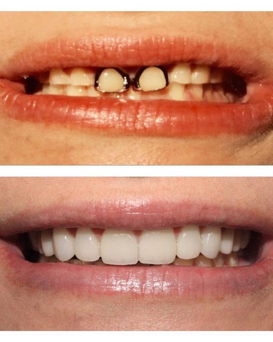 Before and after photos of worn front teeth restored with tooth-coloured filling material