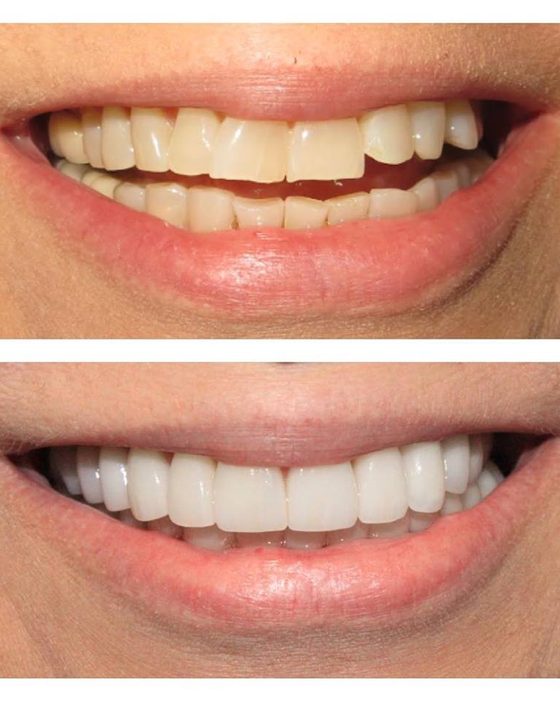 Before and after photos of a smile rebuilt with implant-supported replacement teeth