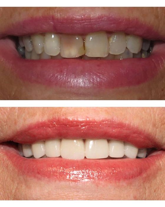 Before and after photos of a gap from a missing tooth filled with a natural-looking replacement