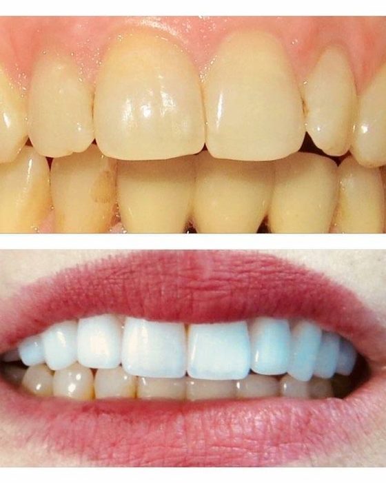 Before and after photos showing teeth several shades brighter after whitening